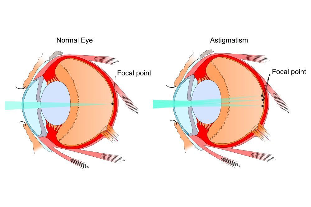 Diagram explaining the difference between a normal eye and one with astigmatism