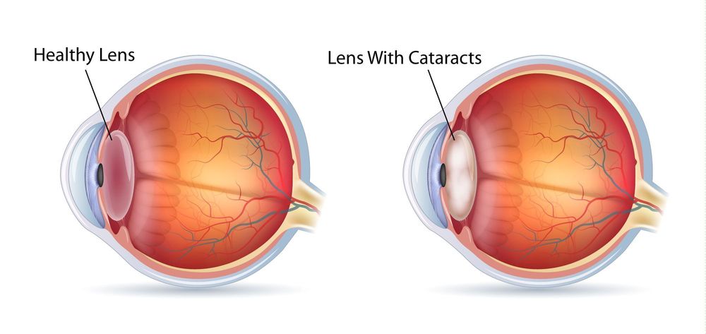 Cataract Diagram