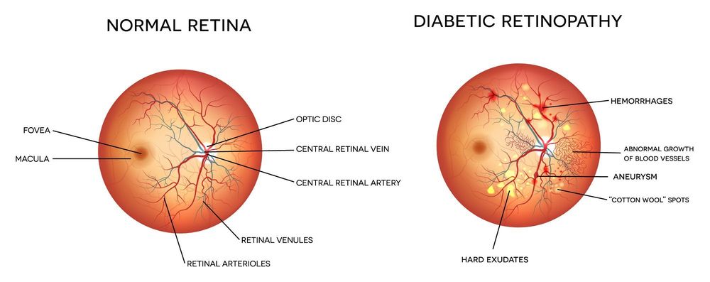 Diabetic Retinopathy Diagram