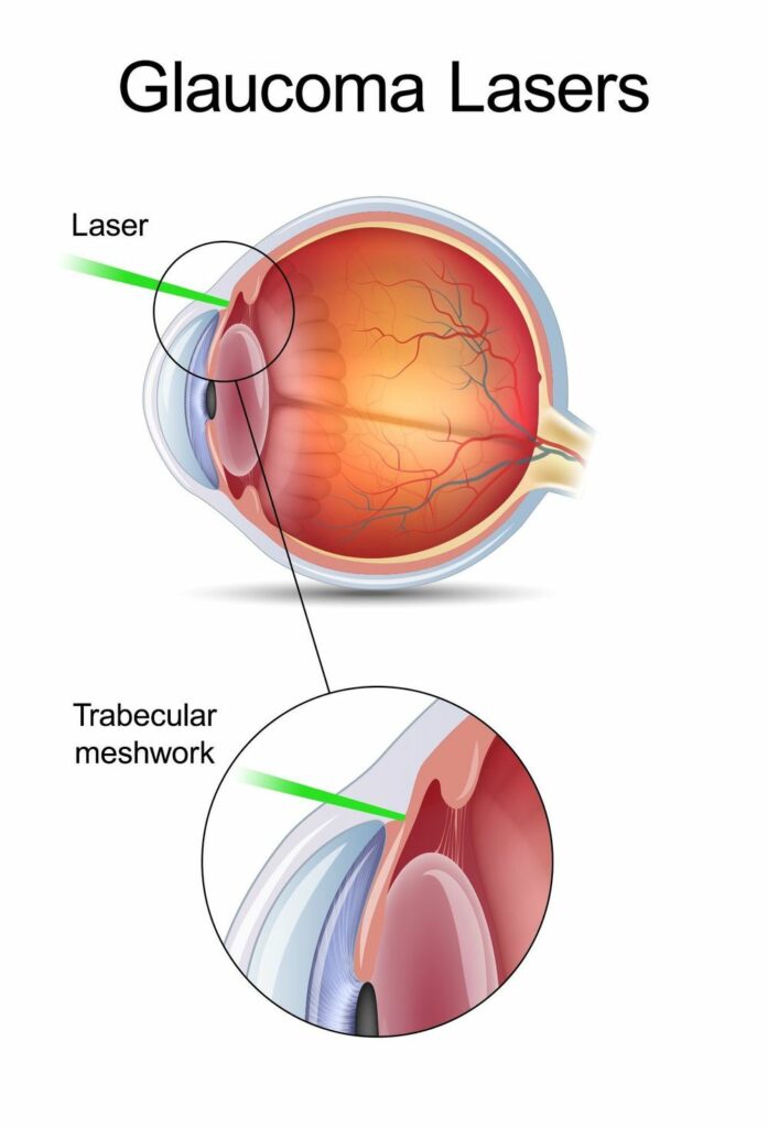 Glaucoma Diagram