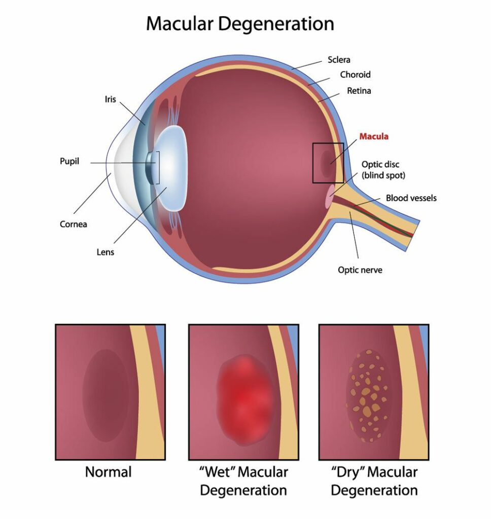 Diagram showing Wet Macular Degenerations and Dry Macular Degerneration