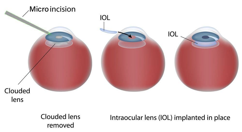 Diagram showing the incision of an IOL